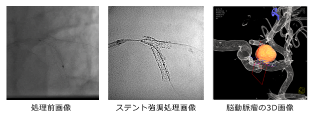 処理前画像,ステント強調処理画像,脳動脈瘤の3D画像